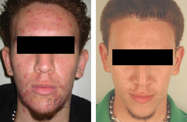 you give does acne propecia