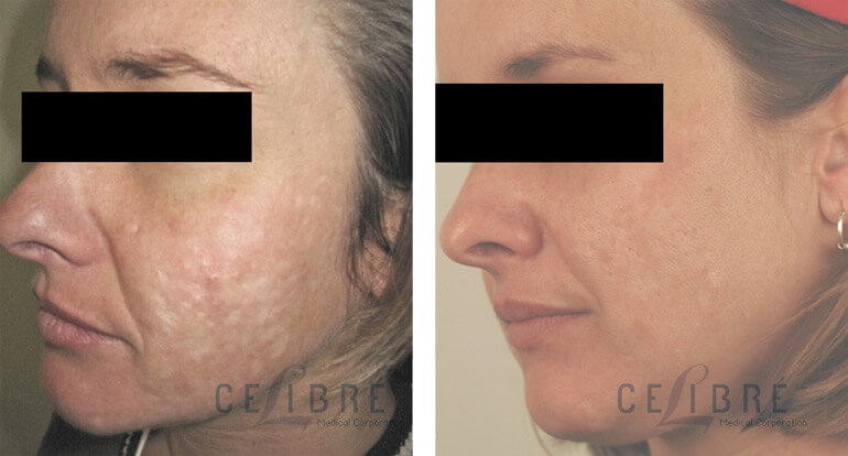 Acne Scars Laser Removal Treatment Before After Pictures 8