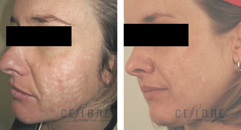 Subcision of Acne Scars - Atlanta Medical Institute