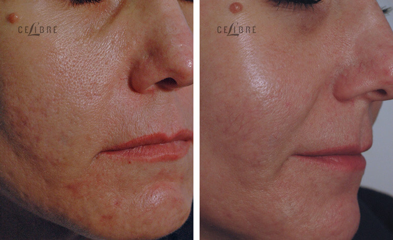 Acne Scars Laser Removal Treatment Before After Pictures 9