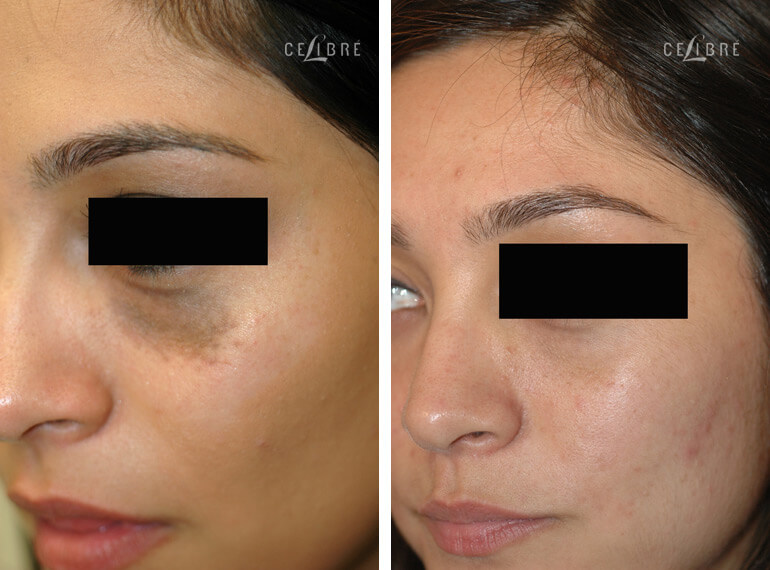 Brown birthmark laser removal under eye before and after photos