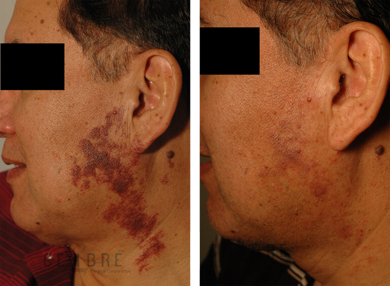 Port wine birthmark removal in Los Angeles, before and after pictures.