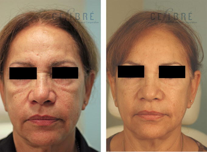 Smooth Wrinkles Instantly With Juvederm Facial Fillers