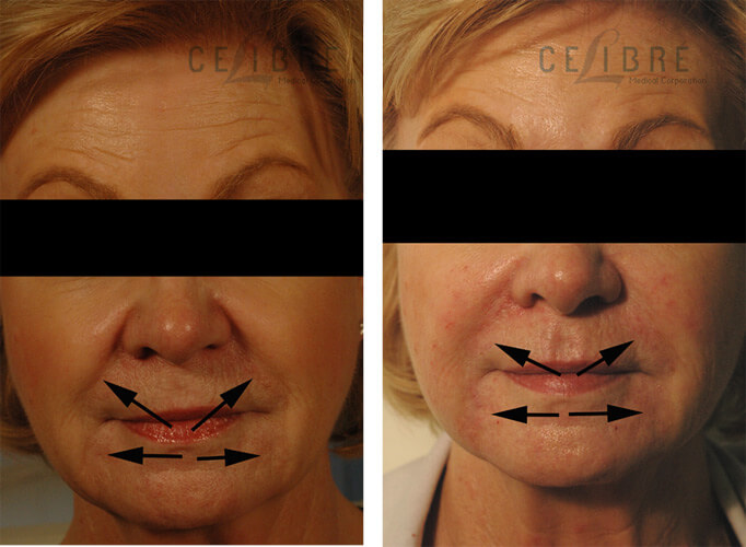 Juvederm Injections Before and After Pictures 3