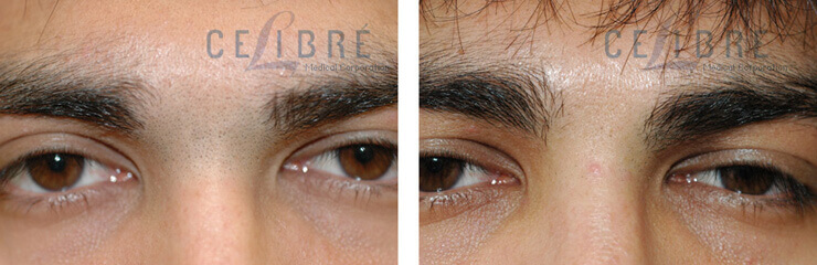 Laser Hair Removal Unibrow Before and After Picture 4