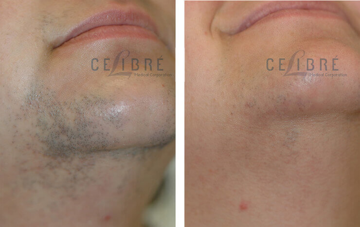 Laser Hair Removal Before and After Pictures 5