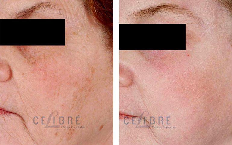 Laser Resurfacing Before and After Pictures 4