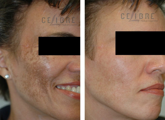 Melasma Before and After Pictures 2
