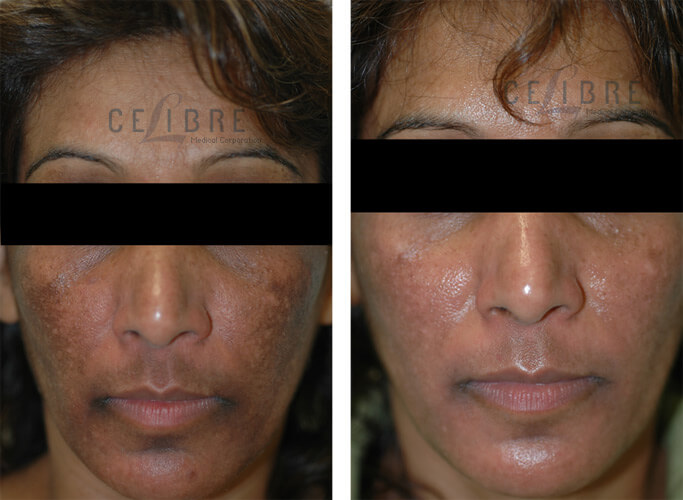 Melasma Before and After Pictures 3