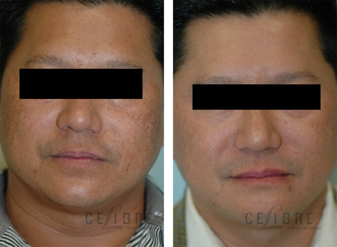 How To Treat Melasma In Men