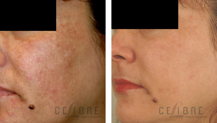 Melasma Before and After Pictures 8