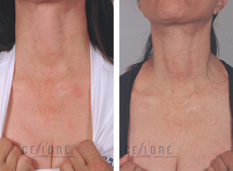 Poikiloderma Laser Treatment Before After Pictures 1