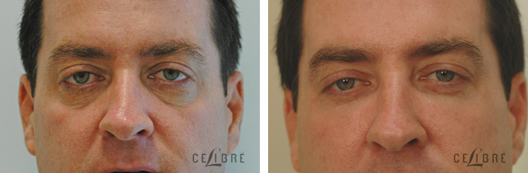 Restylane Injections Before and After Pictures 19 Tired Eyes