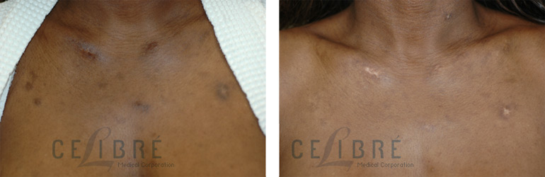 Picking scars after laser treatment and hydroquinone, before and after 