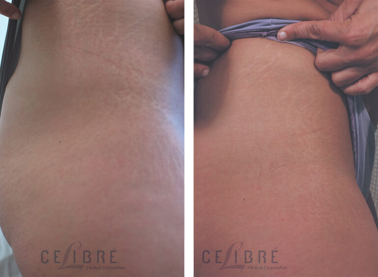 laser stretch mark removal Quotes