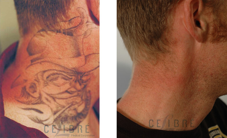 tattoo removal before and after