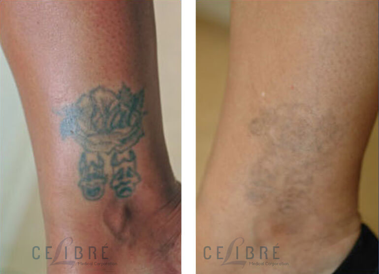 Laser Tattoo Removal Before After Black Skin