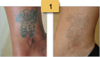Tattoo Removal Before and After Pictures Sm 1