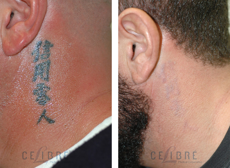 Los Angeles tattoo removal before and after pictures.