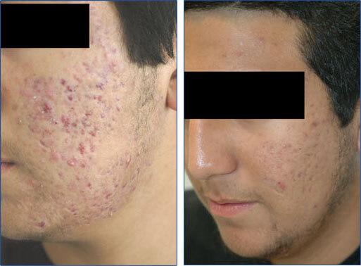 Nonablative Acne Scar Reduction Aftera Series Of Treatments 