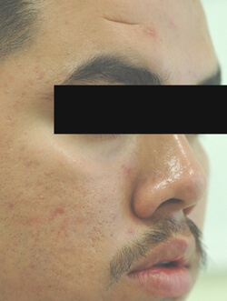 acne scars angeles los treatment before atrophic celibre