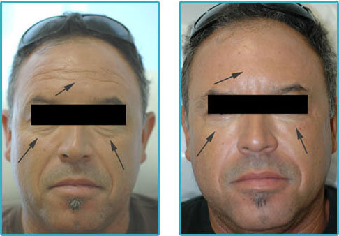 The patient had under eye loss