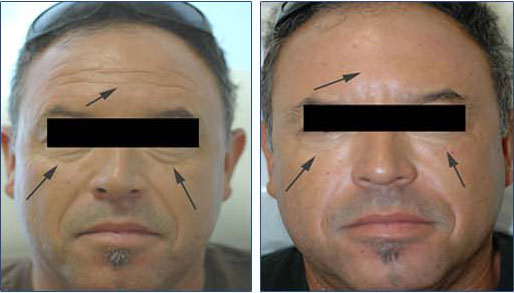 Restylane Under Eyes. Restylane under the eyes.