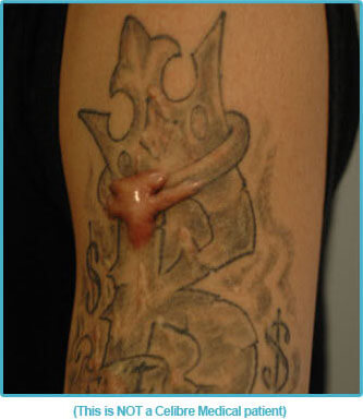 performed by an experienced practitioner, tattoo removal side effects ...