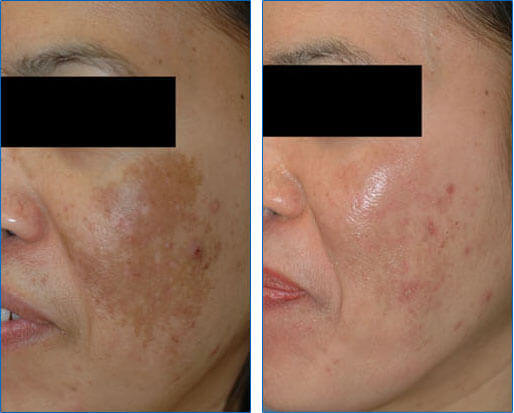 Laser Treatments for Asian Skin - Orange County and Torrance