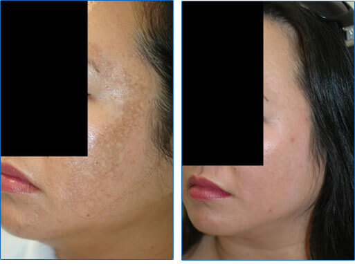 Laser Melasma Treatment in Los Angeles before and after pictures