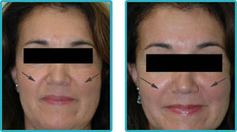 Restylane Cost