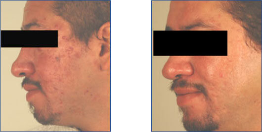 Acne Rosacea Images. Acne Rosacea before and after