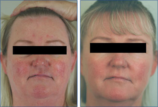 Before And After Vein Treatment. vein treatment before and