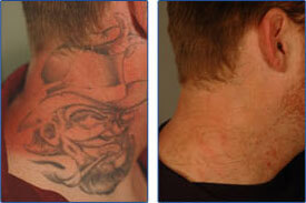 Removal Tattoos on Most Frequently  Tattoo Removal Treatment Is Priced According To The