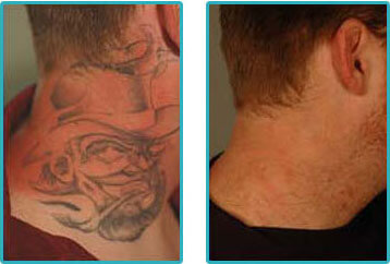 Laser Tattoo Removal Costs Prices