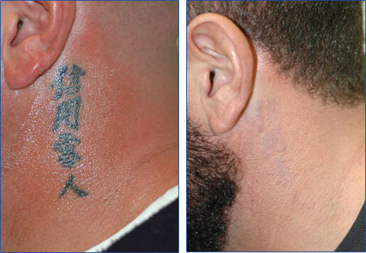 Laser tattoo removal on the neck before and after pictures after 5 NdYg