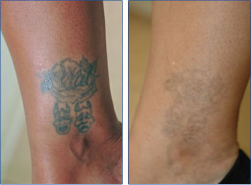 Ankle tattoo removal before and after photos following ONLY 3 laser