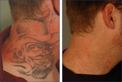 Laser tattoo removal on the neck before and after pictures after 5 NdYg