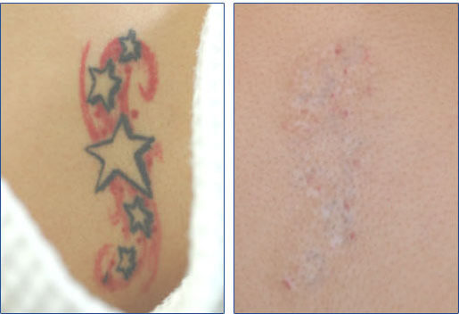 Laser tattoo removal Long Beach CA before and after pictures Laser tattoo removal Long Beach CA before and after pictures